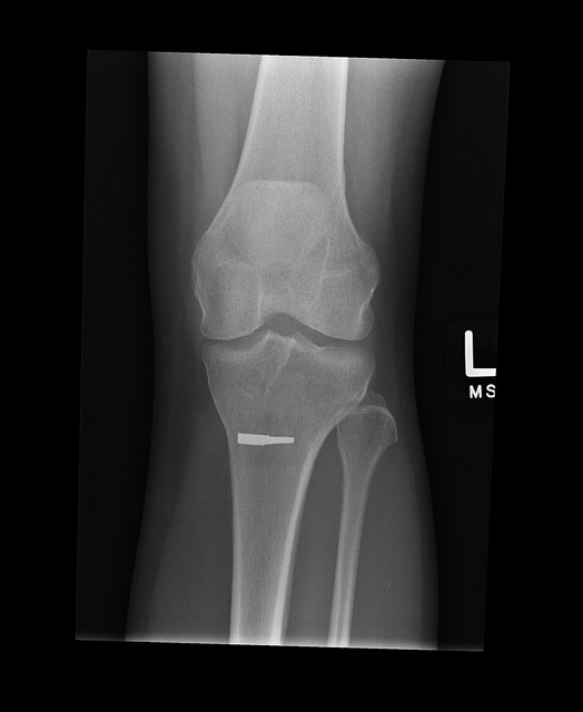 arthritis